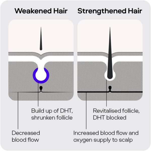 Sons Minoxidil 5% Cutaneous Solution - Precision Application - 3 Month Supply in Reduced Packaging - Image 4